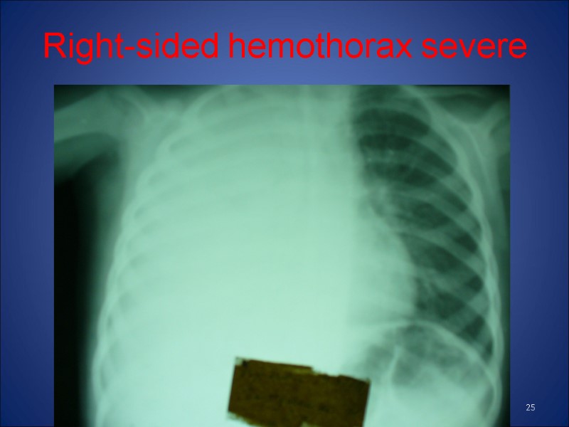 Right-sided hemothorax severe 25